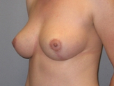 Patient # 97049 After Photo # 4